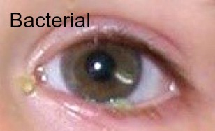Conjunctivitis Bacterial A